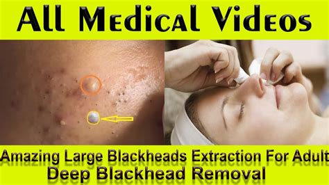 blackhead removal - youtube|extremely huge blackheads removed new videos.